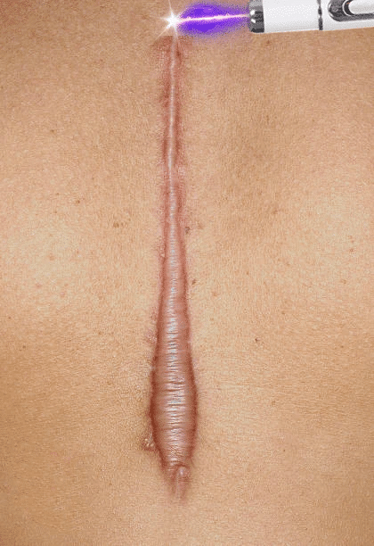 Laser Therapy Keloid Scar