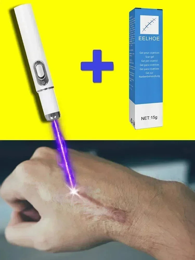 Laser Therapy Keloid Scar