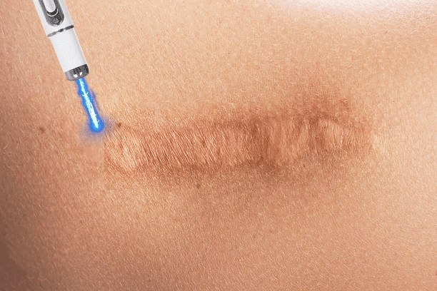 Laser Therapy Keloid Scar