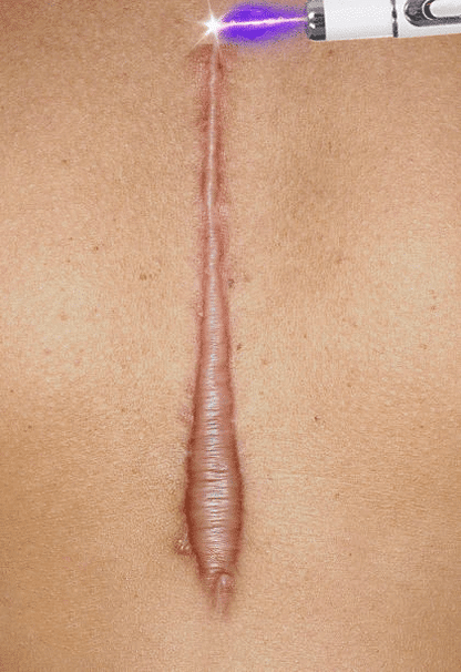 Laser Therapy Keloid Scar Shop1103191015 Store
