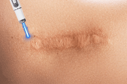 Laser Therapy Keloid Scar Shop1103191015 Store