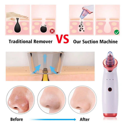 Electric Acne Remover Blackhead Remover Apparatus Teal Simba